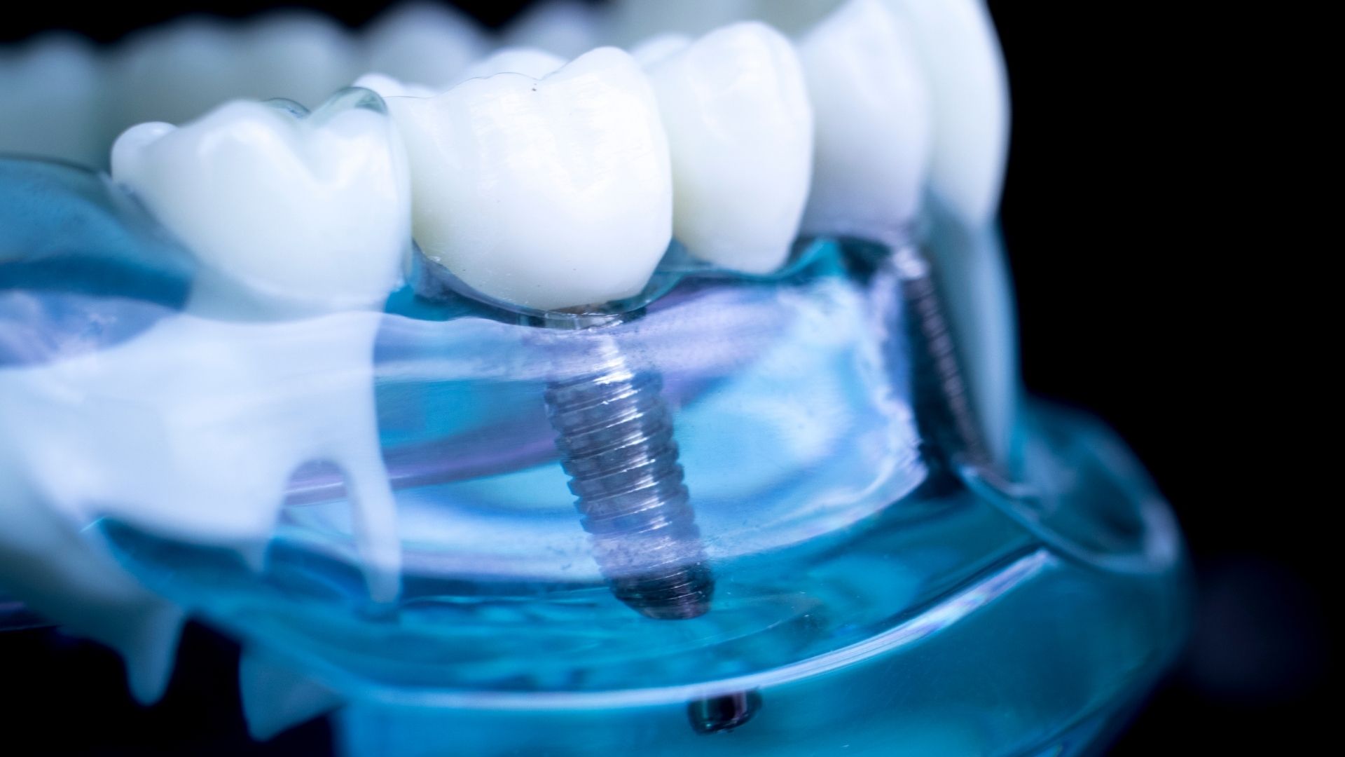 Implantodontia: saiba tudo sobre essa especialidade | Dental Office