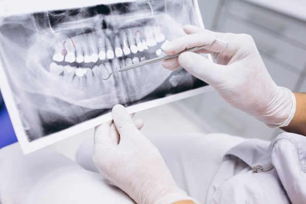 Odontograma: o que é, melhor modelo e como preencher